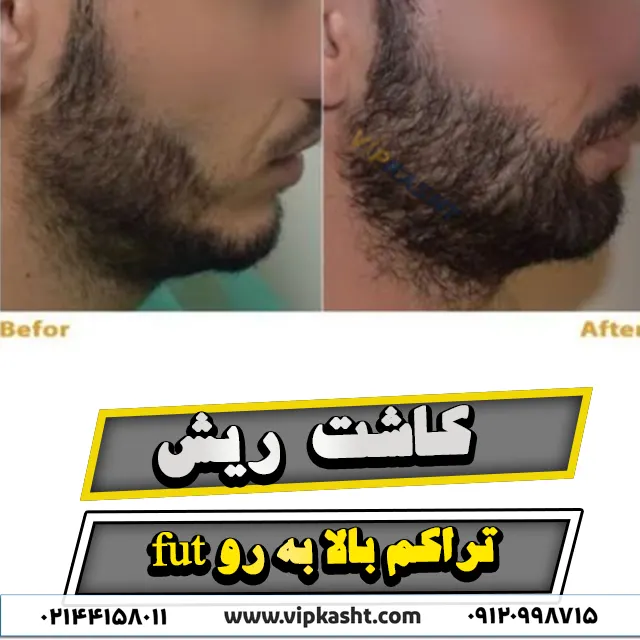 تصویر قبل و بعد از کاشت ریش طبیعی