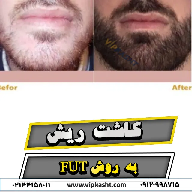 نمونه تصاویر قبل و بعد از کاشت ریش به روش FUT