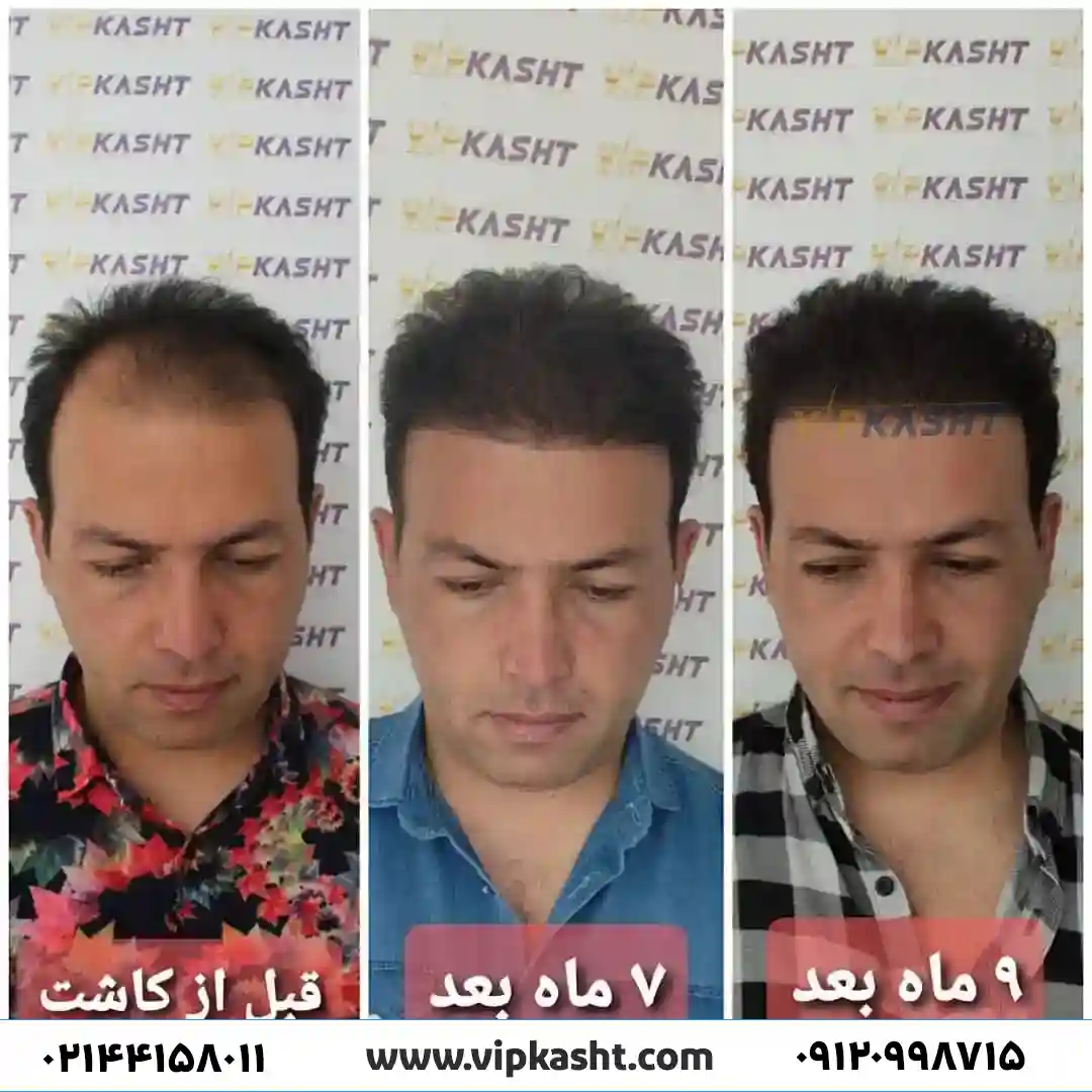 تصویر قبل و بعد از کاشت مو بعد از 9 ماه
