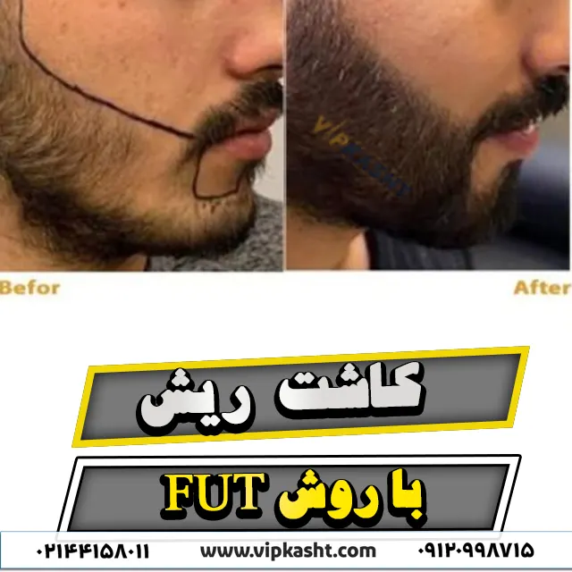 تصویر قبل و بعد از کاشت ریش به روش FUT