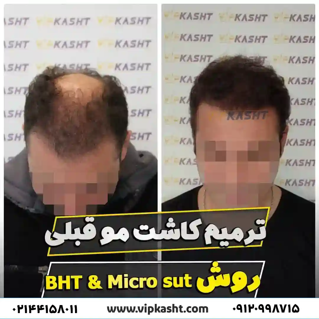 عکس قبل و بعد از کاشت مو به روش میکرو sut