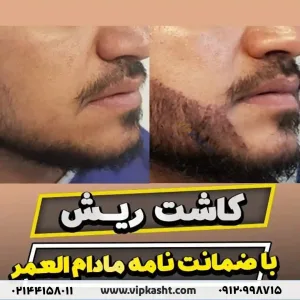 تصاویر قبل و بعد از کاشت ریش