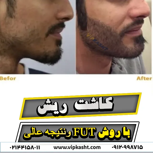 تصویر قبل و بعد از کاشت ریش به روش fut