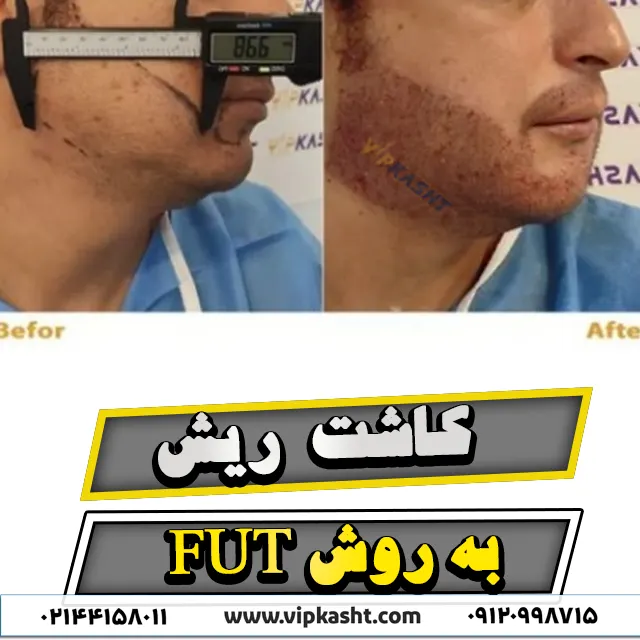 نمونه عکس قبل و بعد از کاشت ریش به روش FUT