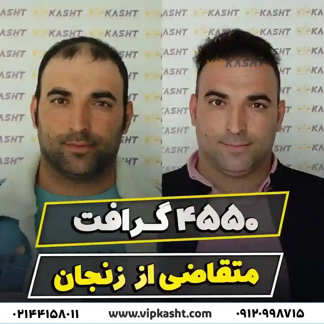 نمونه کاشت مو به کمک 4550 گرافت برای متقاضی از زنجان