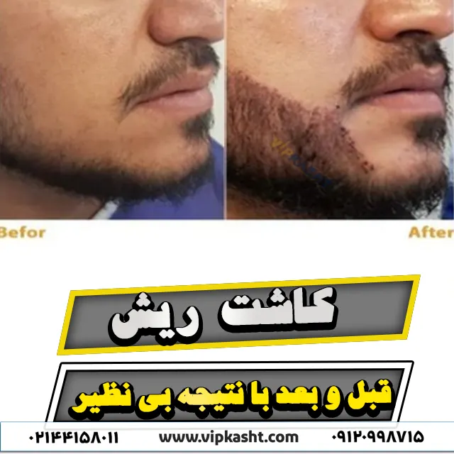 عکس نتیجه قبل و بعد از کاشت ریش را نشان می دهد