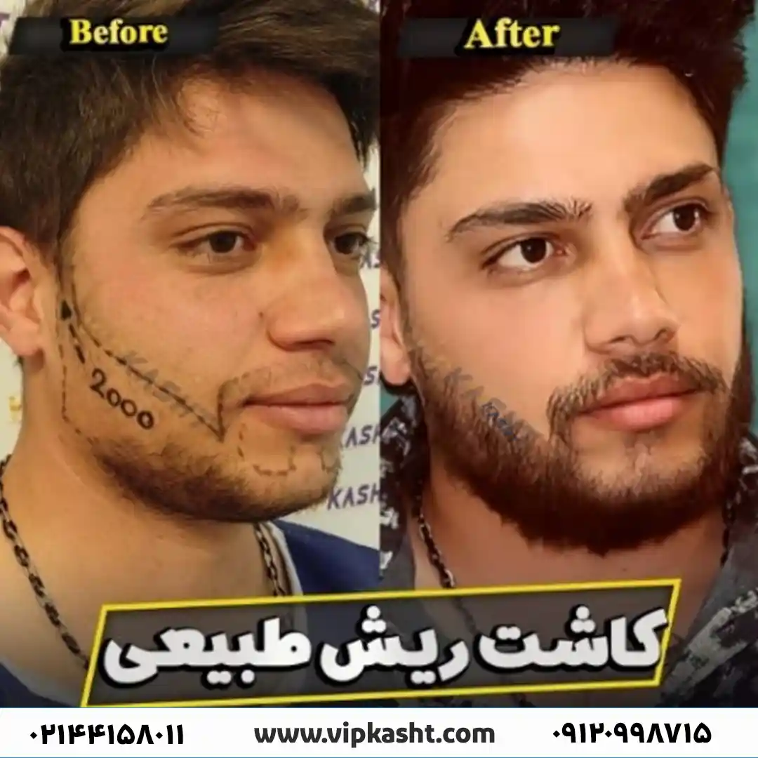 گالری تصاویر قبل و بعد از کاشت ریش به روش FUT