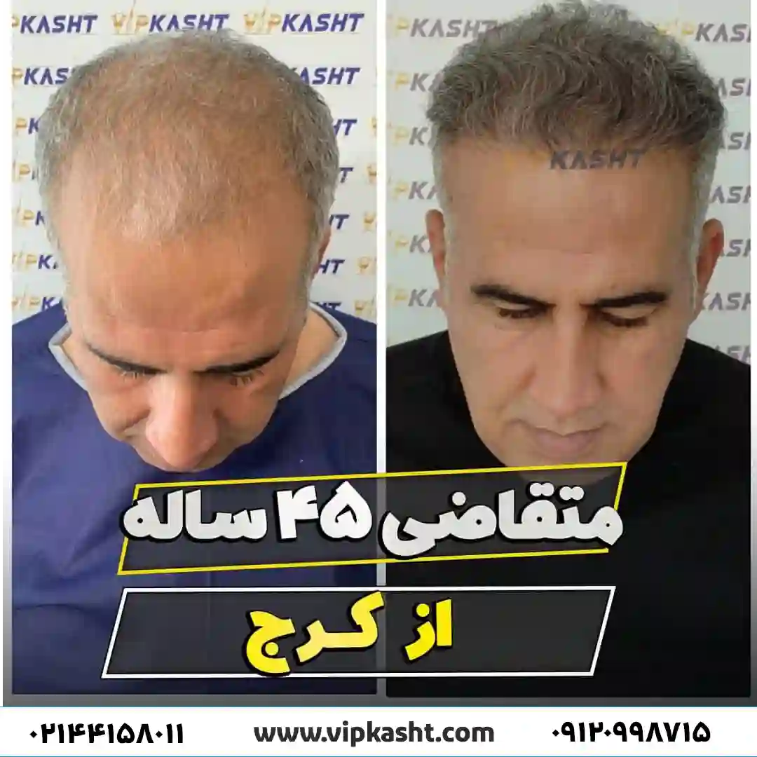تصاویر قبل و بعد از کاشت مو آقای ناصری از کرج