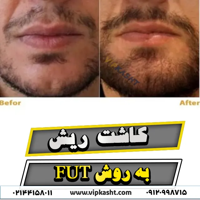 عکس قبل و بعد از کاشت ریش به روش FUT