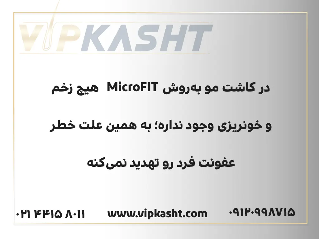 مزایای کاشت مو در تهران به‌روش MicroFIT