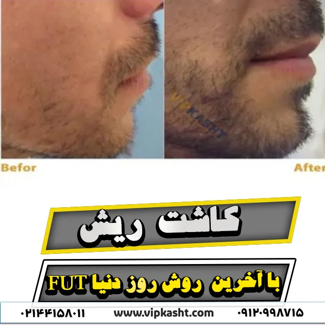 نمونه تصاویر قبل و بعد از کاشت ریش به روش FUT