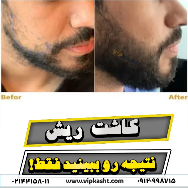 عکس قبل و بعد از کاشت ریش به بهترین روش