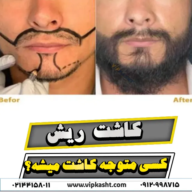 عکس قبل و بعد از کاشت ریش طبیعی