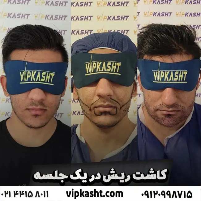 تصاویر قبل و بعد از کاشت ریش برای آقای عباسی در یک جلسه