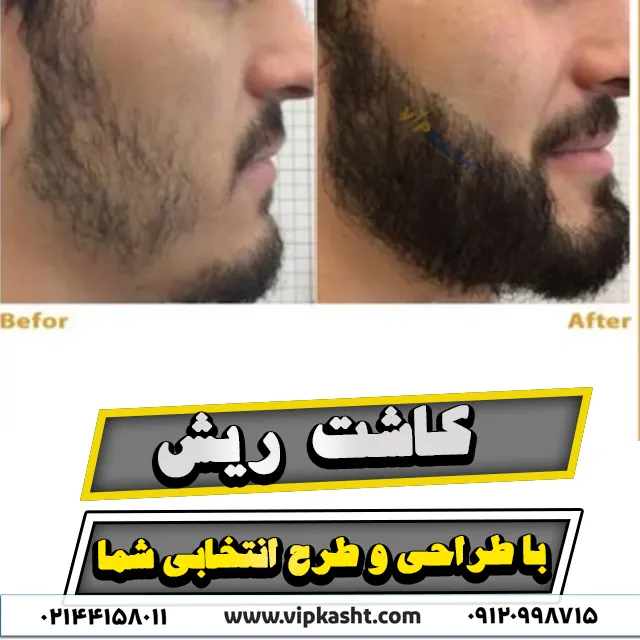 عکس قبل و بعد از کاشت ریش به روش FUT