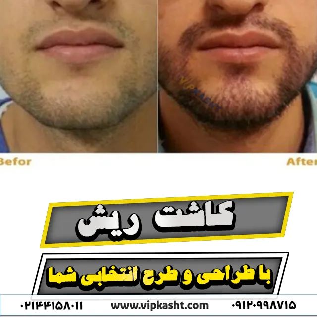 قبل و بعد از کاشت ریش