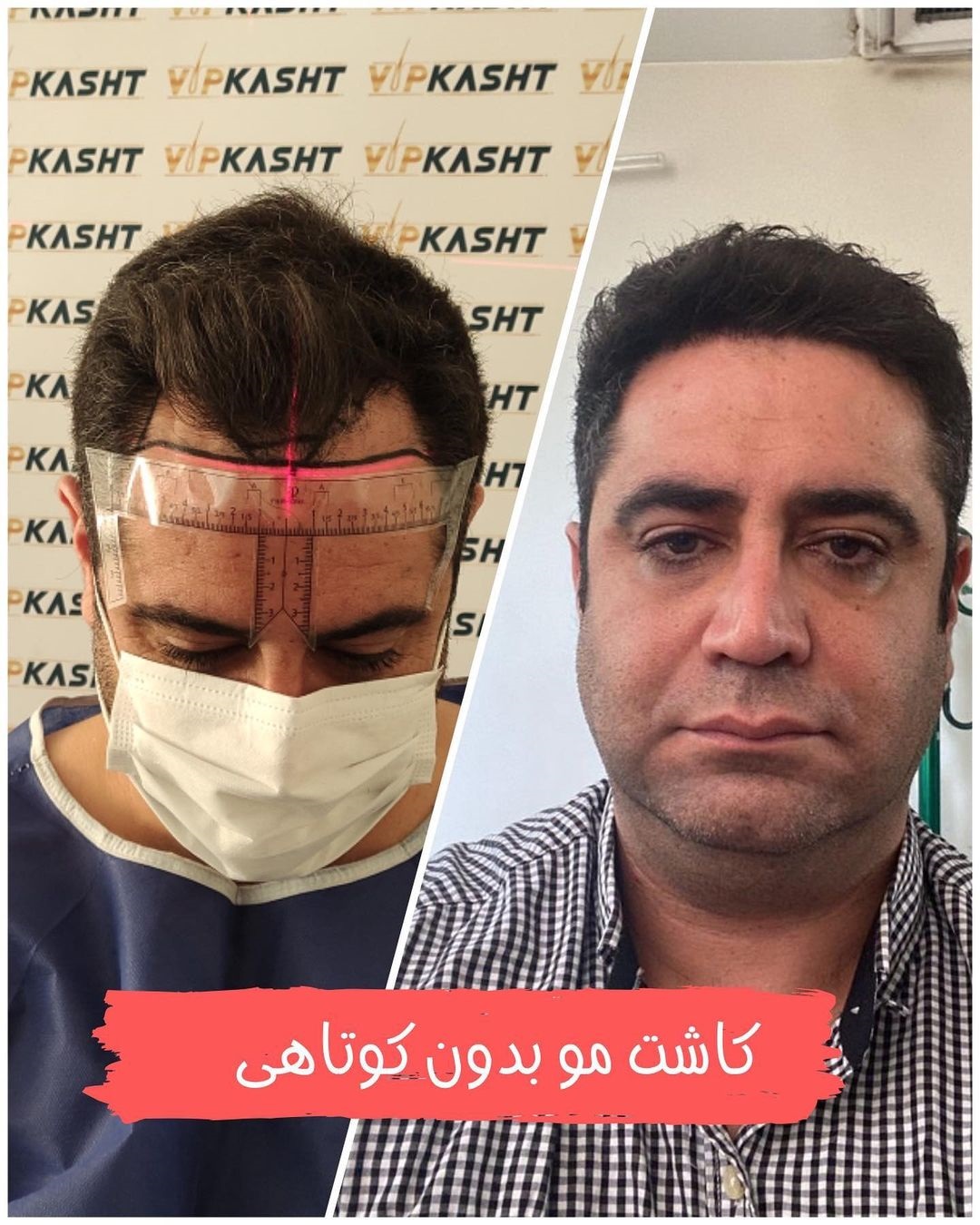 نتیجه کاشت مو در تهران