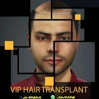 کاشت مو با جدیدترین تکنولوژی در کلینیک vip