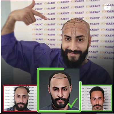 تصاویر قبل و بعد کاشت مو بوسیله اسکن سه بعدی