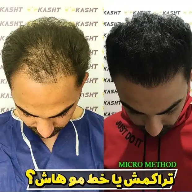 نتیجه کاشت مو طبیعی با تراکم بالا برای متقاضی از تهران