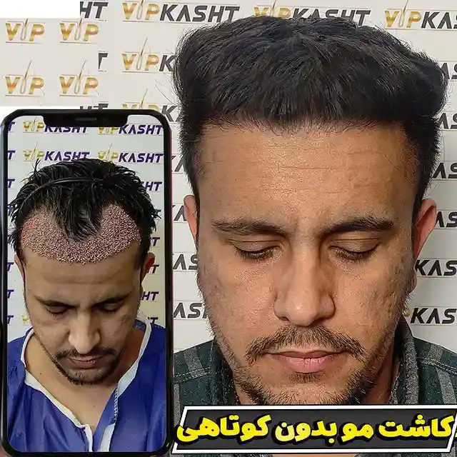 تصاویر قبل و بعد از کاشت مو بدون کوتاهی با نتیجه عالی