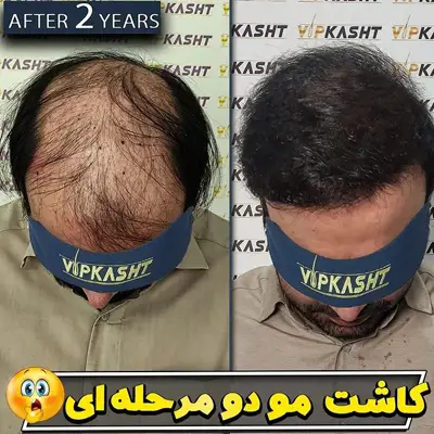 تصاویر قبل و بعد کاشت مو دو مرحله ای