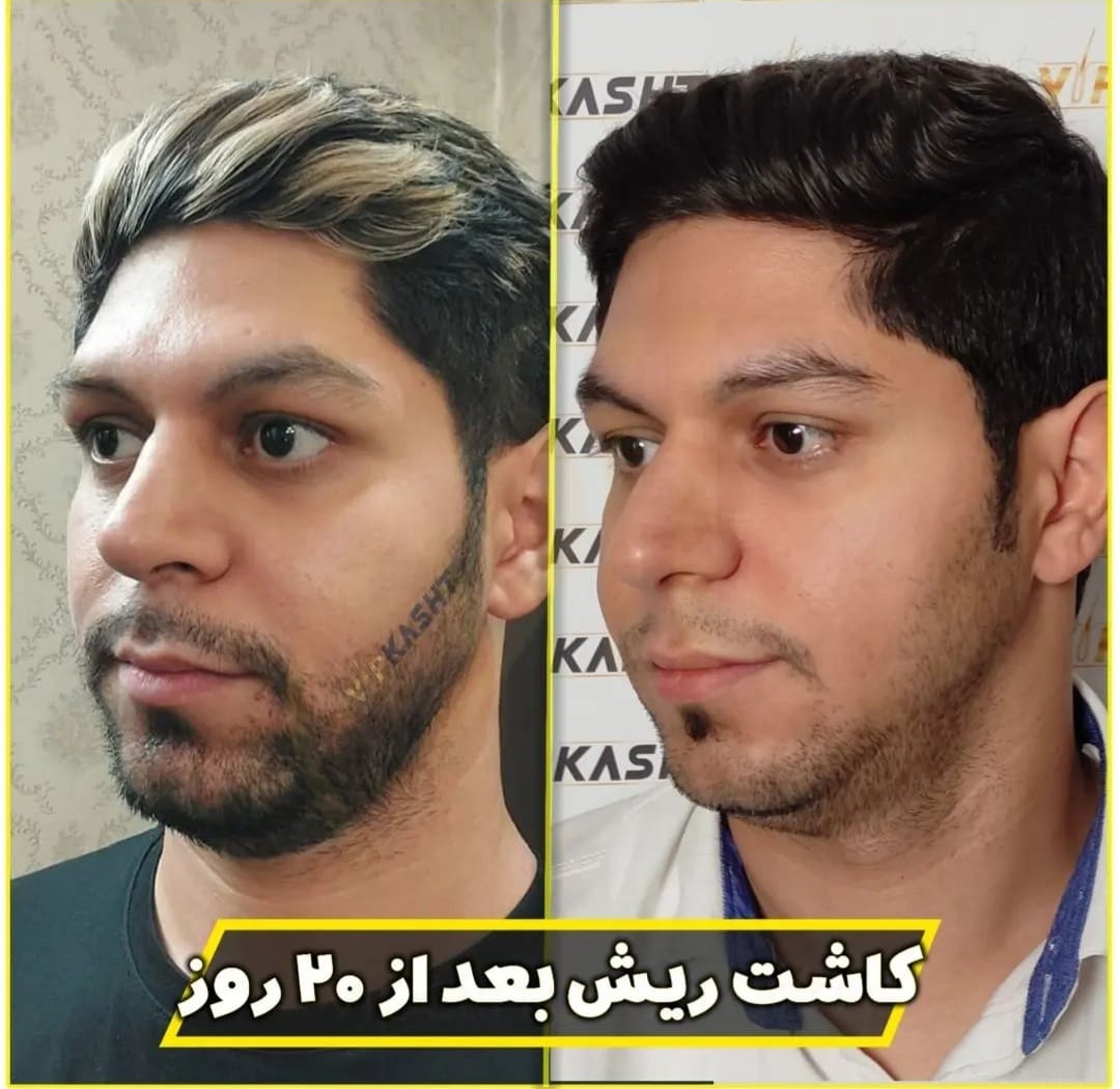 قبل و بعد از کاشت ریش