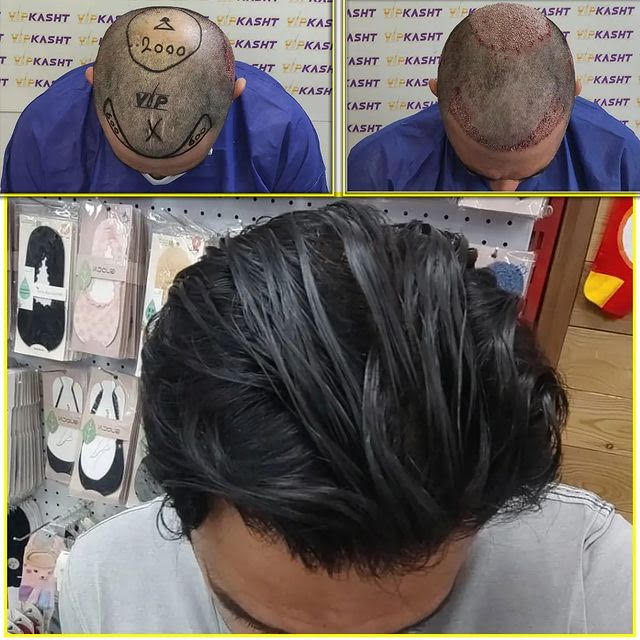 قبل و بعد کاشت مو