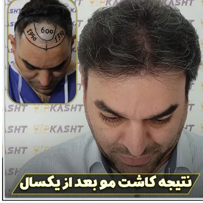 عکس کاشت مو در تهران در کلینیک vip