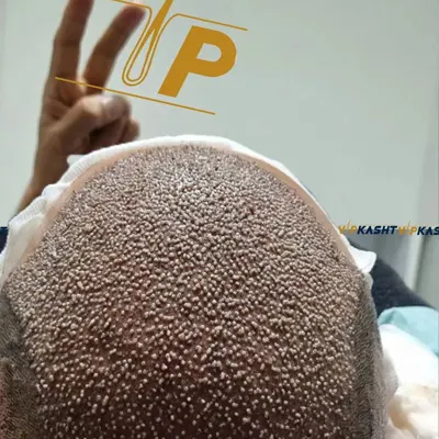 نتیجه کاشت مو با تراکم بالا در کلینیک vip
