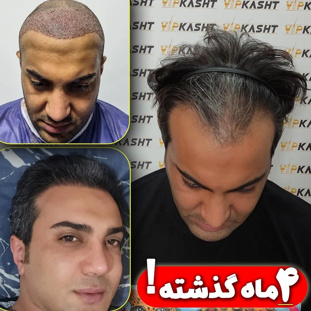 نتیجه کاشت موی آقای حسینی بعد از یک سال