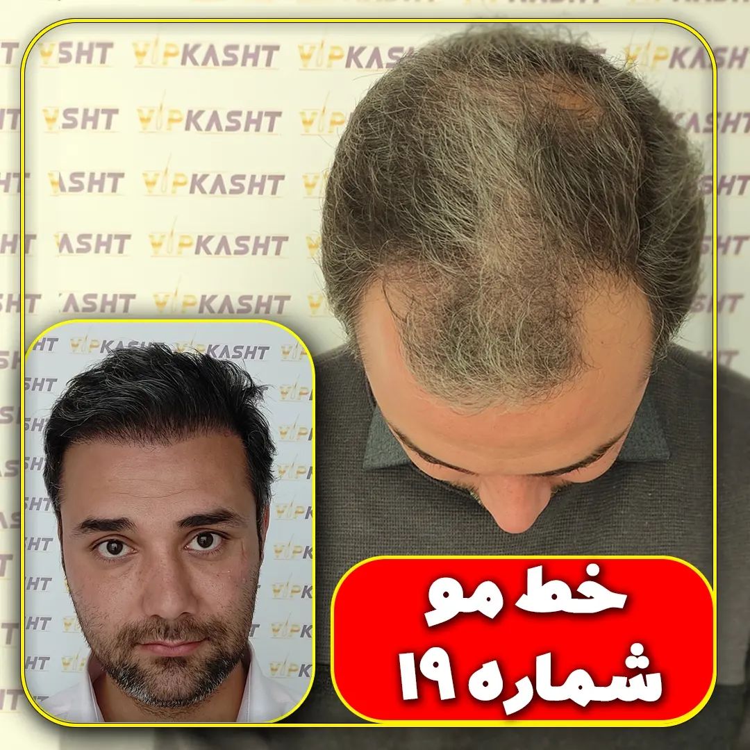 نتیجه کاشت موی آقای سهیلی از تهران بعد از یک سال
