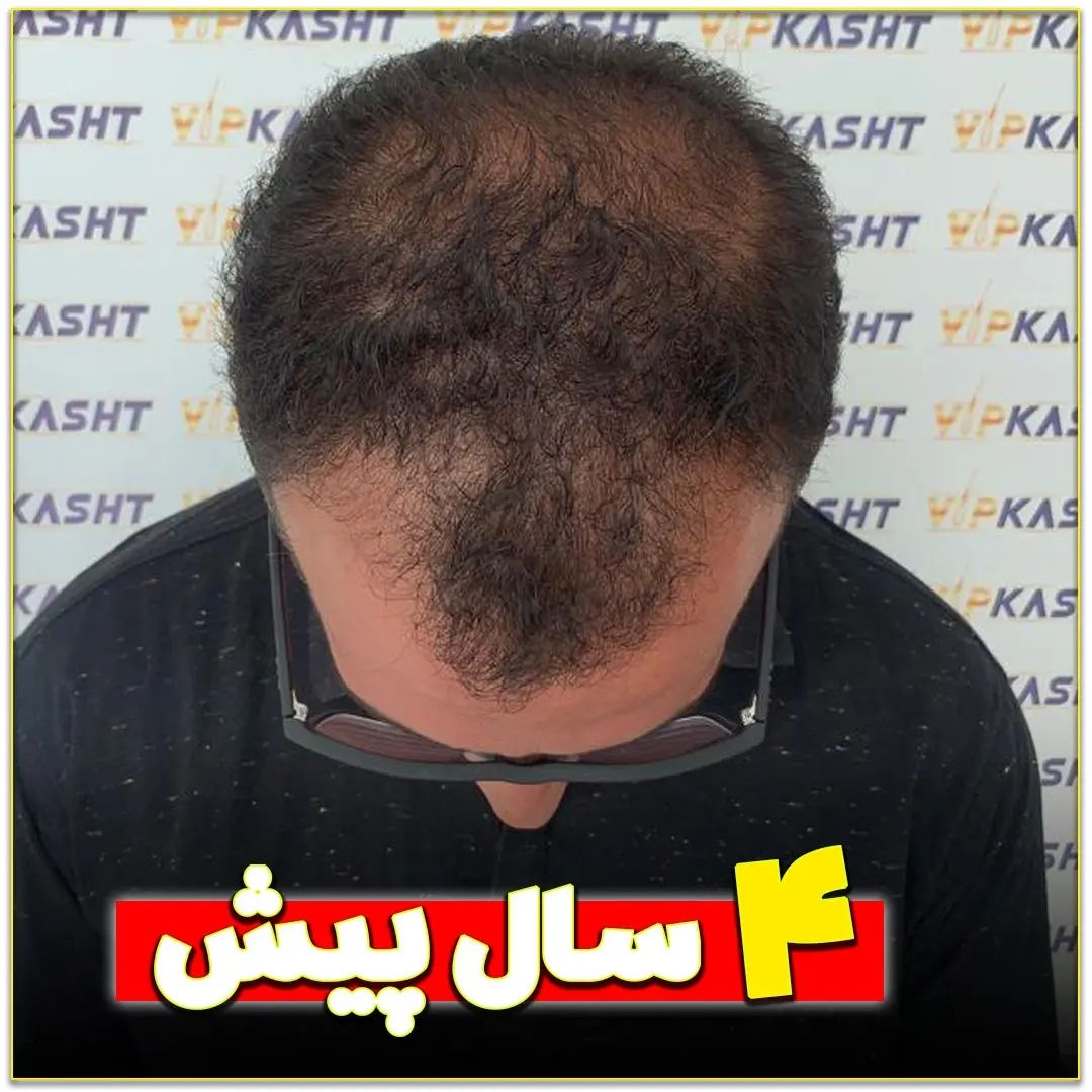 چطور بهترین پزشک کاشت مو در تهران را انتخاب کنیم؟